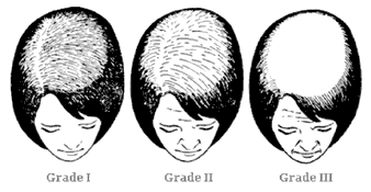 Klassifizierung Haarausfall Frauen