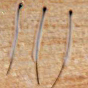 Haarfollikel bei einer Haarverpflanzung